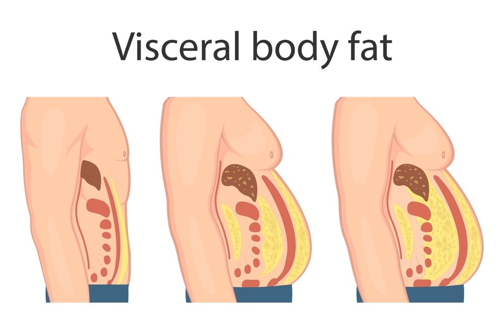 liposuction vs healthy diet